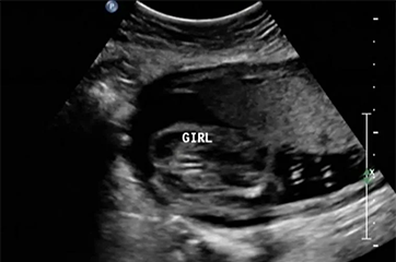 Gender Scan - After 16 Weeks (Including the growth of the baby)